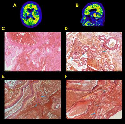 Diagnostic Utility of Integrated11C-Pittsburgh Compound B Positron Emission Tomography/Magnetic Resonance for Cerebral Amyloid Angiopathy: A Pilot Study